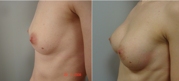 Okrugli implantati  - 225mL